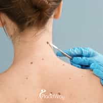 Melanoma That Has Spread Beyond the Skin: Advanced Treatment Options in Mexico